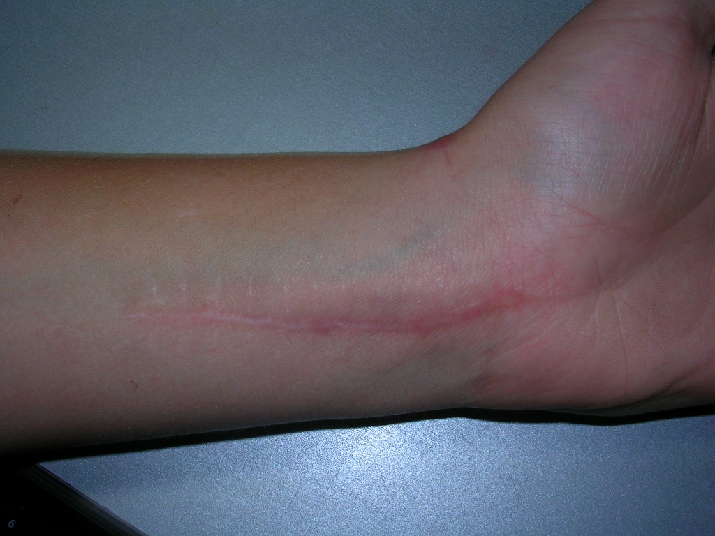 Abortion Scar